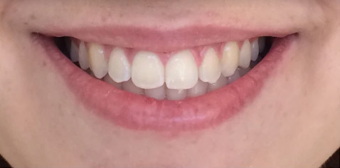 antes-depois-RESTAURACAO-ESTETICA-ARAUJO-ODONTOLOGIA-01