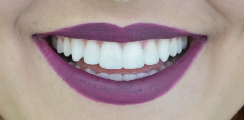 antes-depois-RESTAURACAO-ESTETICA-ARAUJO-ODONTOLOGIA-01B