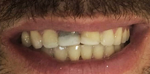 antes-depois-RESTAURACAO-ESTETICA-ARAUJO-ODONTOLOGIA-07-antes