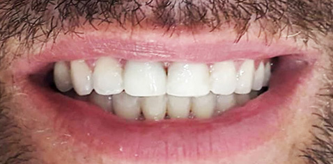 antes-depois-RESTAURACAO-ESTETICA-ARAUJO-ODONTOLOGIA-07